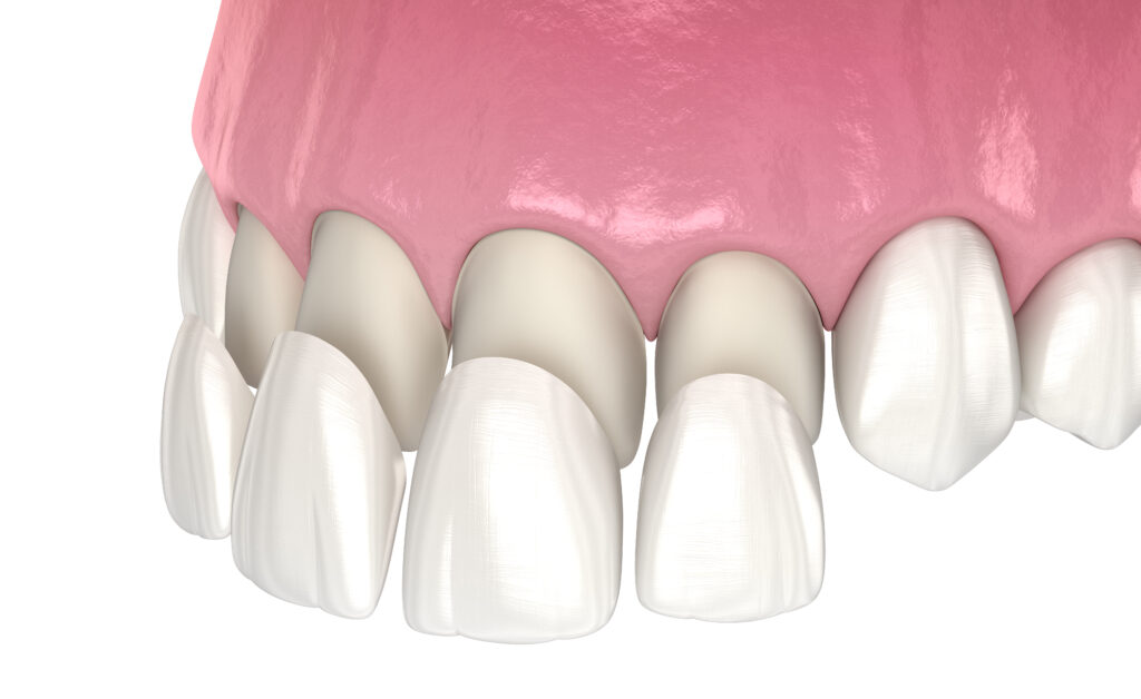 Dental Veneers Diagram Dentist in Wallingford